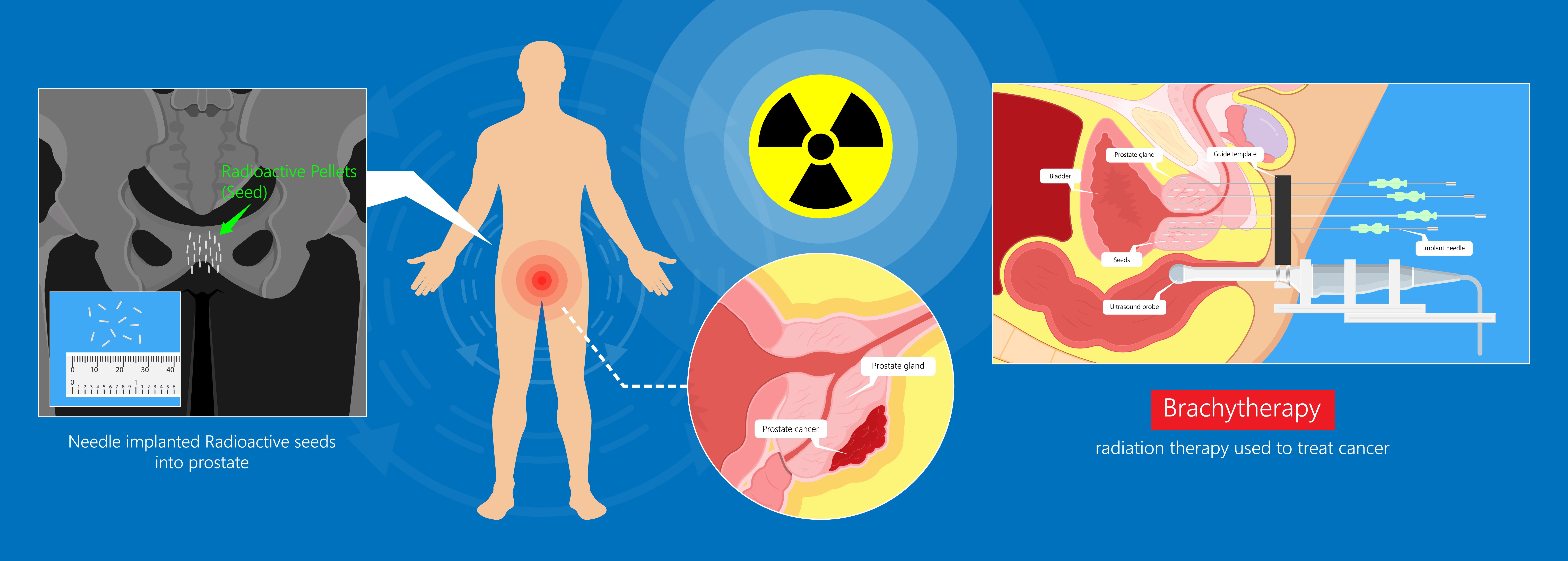 Prostate seed procedure diagram explaining brachytherapy